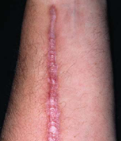 Keloid scar